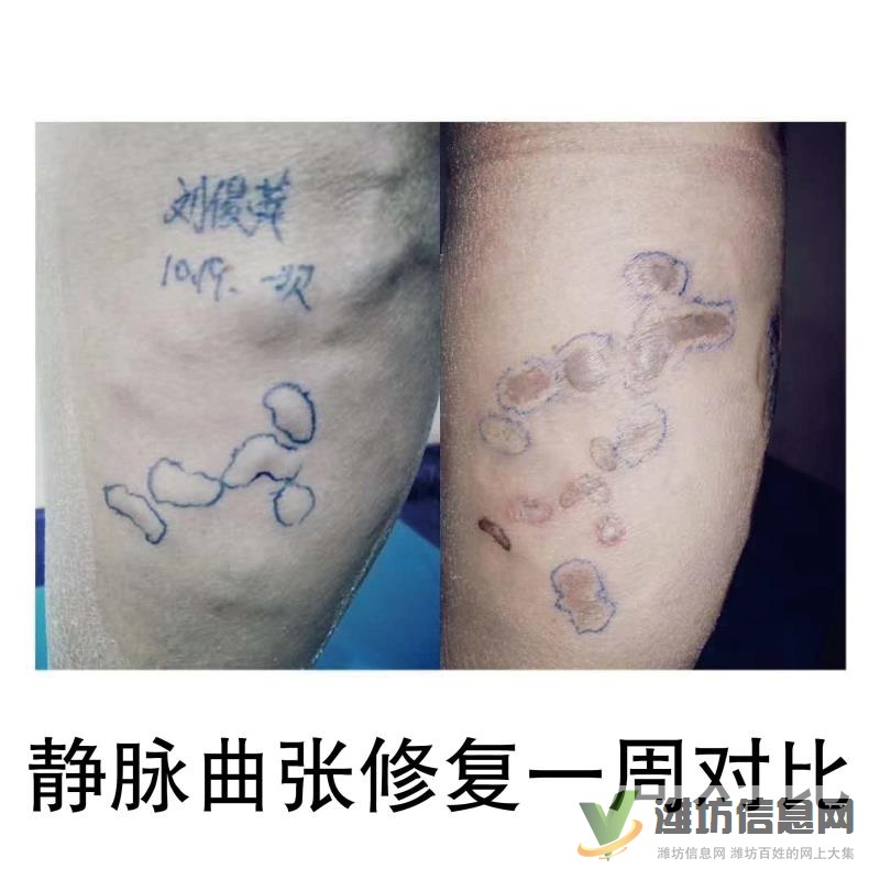 墨龍御靜脈曲張修復(fù)